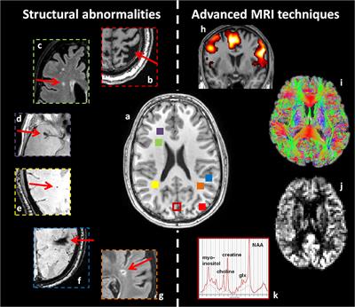 Cerebral Pathology and Cognition in Diabetes: The Merits of Multiparametric Neuroimaging